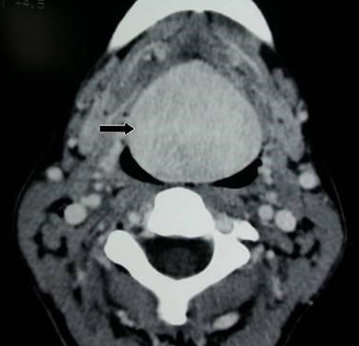 Axial computed tomography-scan with contrast showing a large 6 × 4 × 3.5 cm3 lingual tumor (black arrow).