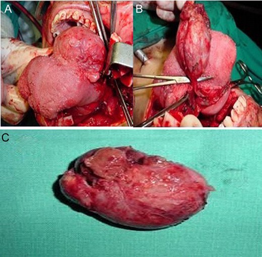 Open approach with mandibular split (A), en-block resection of the lingual thyroid (B), final specimen (C).