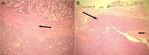 (A) The nodule shows a microfollicular and trabecular architecture (lower part). It is well demarcated from the lingual thyroid tissue (upper part) by a fibrous capsule (arrow). (B) A mushroom-shaped throng of neoplastic follicular cells (long arrow) is seen invading through the capsule (short arrow).