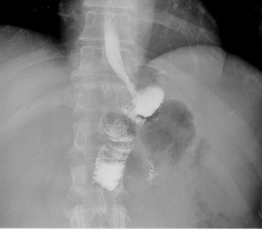 Post-op upper GI, was normal.