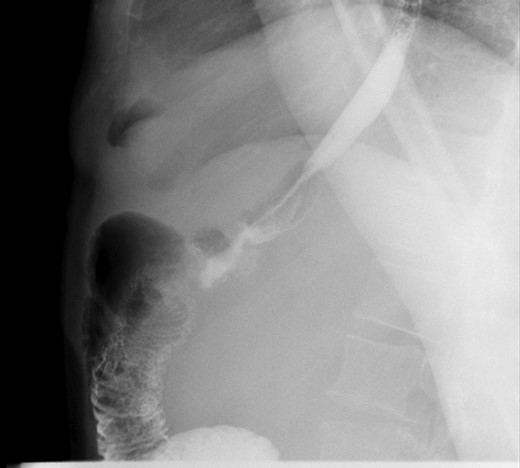 Post-op upper GI after resection of redundant limb.