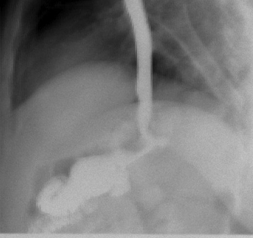 Patient post-op upper GI was normal after resection.