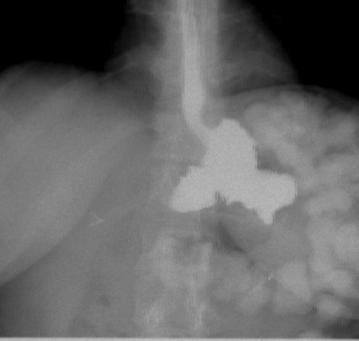 Patient post-op upper GI after resection.