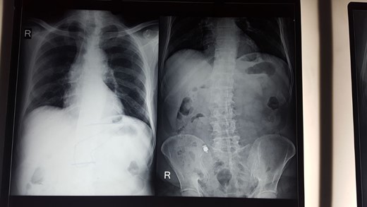 X-ray abdomen shows capsule in right lower abdomen.