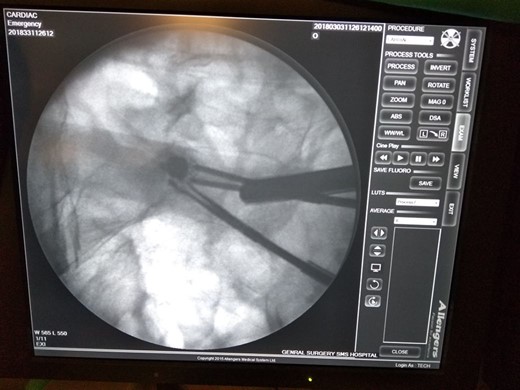 C-arm image.