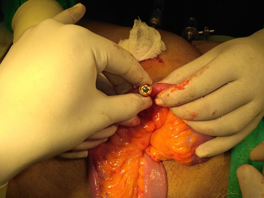 Removal of retained video capsule endoscope.