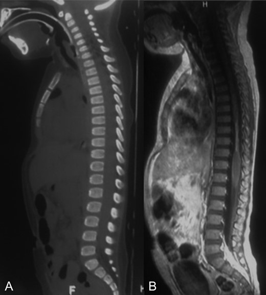 A-B: A. Sagittal bone window of spine showing normal alignment and no fracture. B. Sagittal T1 contrast enhanced sequence showing a narrowed spinal cord from T7 to T10 that could correspond to gliosis and edema.