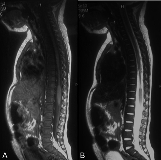 A-B: A. Sagittal T1 sequence showing a narrowed spinal cord from T7 to T10. B. Sagittal STIR-weighted MRI of the thoracic spine showing chronic appearance of a string-like atrophic cord.