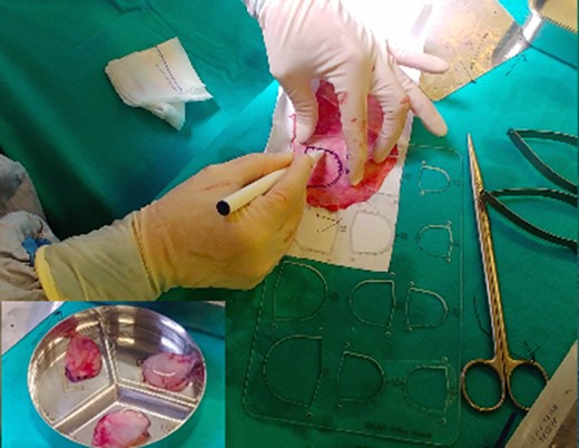 Trimming the pericardium according to each cusb size. The stitch points are marked on the pericardium.