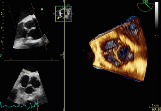 Postoperative 3D echocardiographic view shows perfect competent neovalves.