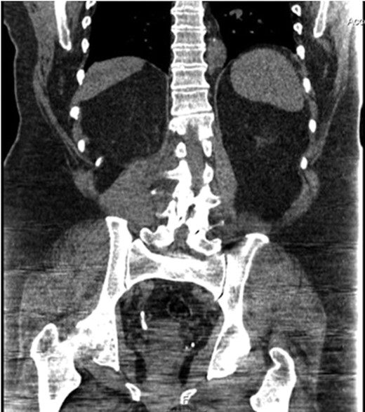 CT scan demonstrating contiguous right distal ureteric calculi measuring 7 mm by 22 mm.