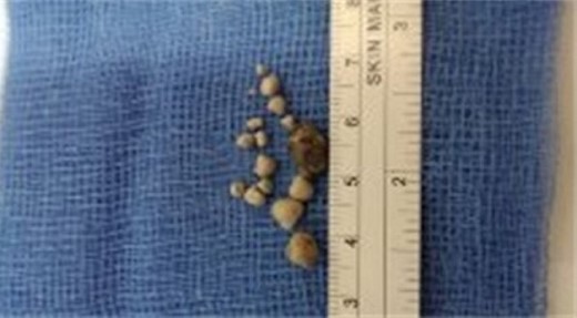 Image of stones passed by patient measuring between 2 and 10 mm in length.