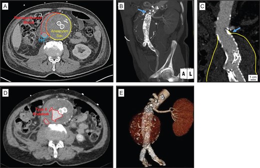 Ruptured AAA in the setting of large chornic Type II endoleak and inadequate proximal aortic endograft seal. (A) Emergency room CT demonstrated retroperitoneal stranding and blood consistent with aortic aneurysm rupture. (B) Left anterior oblique MIP reconstruction image demonstrates previously placed infrarenal modular bifurcated Gore® Excluder® aortic endograft, a single patent left renal artery, and mild aneurysmal degeneration in the juxta-renal aorta (blue arrow). (C) Coronal CTA demonstrates aneurysm sac extending to the level of the proximal Excluder® endograft directly below the level of the left renal artery (blue arrow). (D) CTA demonstrated large Type II endoleaks, adjacent to the level of the aortic aneurysm sac rupture site. (E) Left anterior oblique 3D reconstruction illustrates position of previously placed infrarenal aortic endograft and bilateral iliac limb extensions in the proximal common iliac arteries.