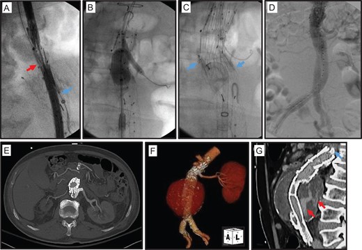 Extension of proximal aortic endograft seal to the para-renal aorta. (A) Placement of a Cook Zenith Renu® endograft cuff (red Arrow) from a right common femoral artery cannulation. A 7 Fr sheath (blue arrow) was also advanced into the proximal left renal artery from a left proximal brachial artery cannulation. (B) Molding of deployed Renu® cuff and a 6 × 22 mm2 AtriumTM iCASTTM stent in the proximal left renal artery. (C) Further fixation of deployed Renu® cuff with AptusTM EndoAnchorTM staples (blue arrow). (D) Completion aortogram demonstrates brisk flow in the aortic endograft and left renal artery. (E–G) Post-operative CTA demonstrates well positioned aortic endograft and adjacent snorkel left renal artery stent.
