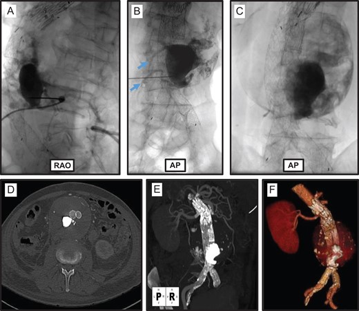 Trans-lumbar aortic sac embolization. Right anterior oblique (RAO; A) and anterior-posterior (AP; B) projections of trans-lumbar aortic puncture and angiogram demonstrating a large Type II endoleak originating from L3 and L4 lumbar arteries (blue arrows). (C) Completion fluorogram demonstrates NBCA/Ethiodol glue embolization of the Type II endoleak. (D–F) Post-procedure CTA demonstrates successful embolization of aortic sac Type II endoleak.