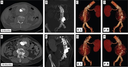 Post-operative follow-up CTA imaging. CTA performed at 5 months (A–D) and 18 months (E–H) demonstrates stable repair of aortic aneurysm, with continued aortic endograft and left renal artery stent patency, and no evidence of persistent endoleaks.