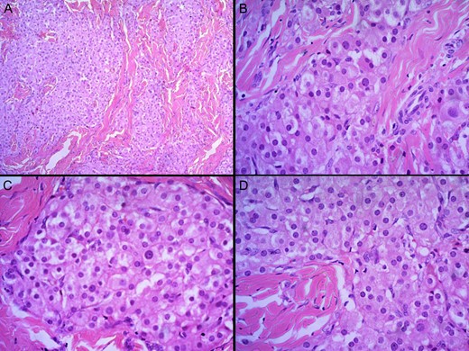 H and E staining viewed under ×4 (A) and ×40 (B–D) showing nodules of cells with intervening dense fibrous septae. The nodules comprised nests and cords of polygonal Leydig cells with abundant eosinophilic cytoplasm, uniform round nuclei and small nucleoli. Cell borders were distinct and a lymphoid infiltrate was present in the stroma.