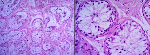 H and E staining viewed under ×4 (A) and ×40 (B) showing testicular tissue comprised of seminiferous tubules with thickened basement membranes. Residual testicular tissue showed predominantly germ cell aplasia with an occasional tubule containing spermatogonia.