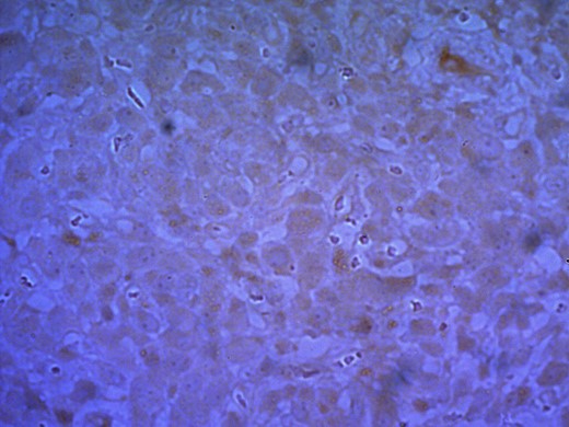Staining with synaptophysin under ×40 showing diffuse cytoplasmic positivity.