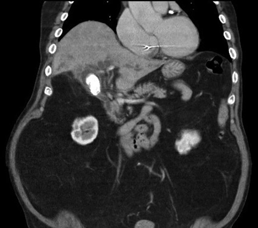 Computed tomography of the abdomen showing a gallstone compressing onto the common hepatic duct.