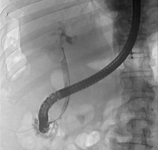 Cholangiogram demonstrating filling defects at the common hepatic duct.