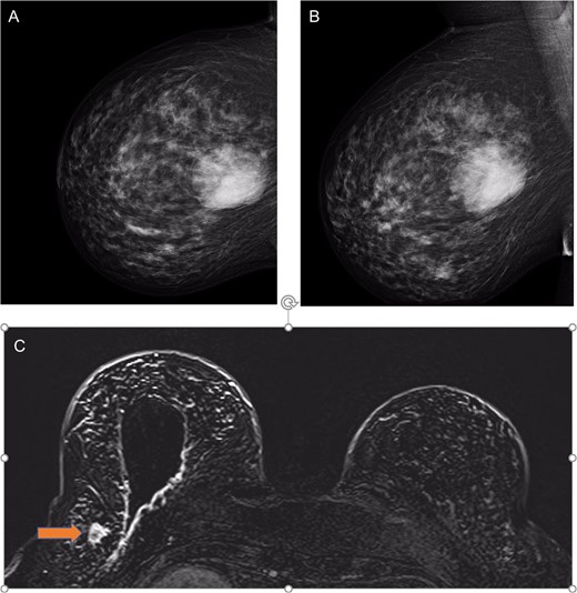 (a) Right mammogram cranial–caudal and (b) medial lateral oblique views showing the 65 mm phyllodes tumour; and (c) MRI T1 views with post-surgical wide local excision cavity and synchronous lobular carcinoma (labelled by orange arrow).