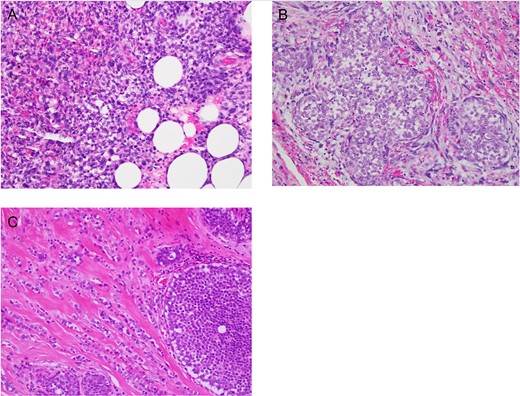 High power (×400) photomicrographs of Haematoxylin and Eosin stained slides showing (a) malignant phyllodes with infiltration beyond its margin to the breast fat, (b) lobular carcinoma in situ in margin next to malignant phyllodes and (c) lobular carcinoma with lobular carcinoma in situ.