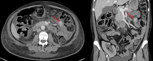 Small bowel mass on computed tomography abdominoplevic scan.