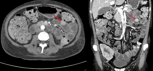 Small bowel mass on computed tomography enterography.
