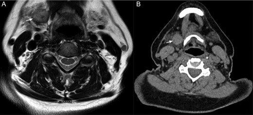 The white arrow shows the right submandibular gland in (A) magnetic resonance in T1 and (B) CT scan.