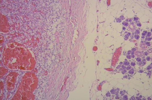 Renal clear cell carcinoma metastasis to submandibular gland (right). Submandibular glandular parenchyma with a well circumscribed tumor (left) composed of an alveolar, tubular and cystic, clear cell tumor with distinct but delicate cell boundaries and a characteristic network of small, thin walled vasculature. (Hematoxylin–eosin ×100.)