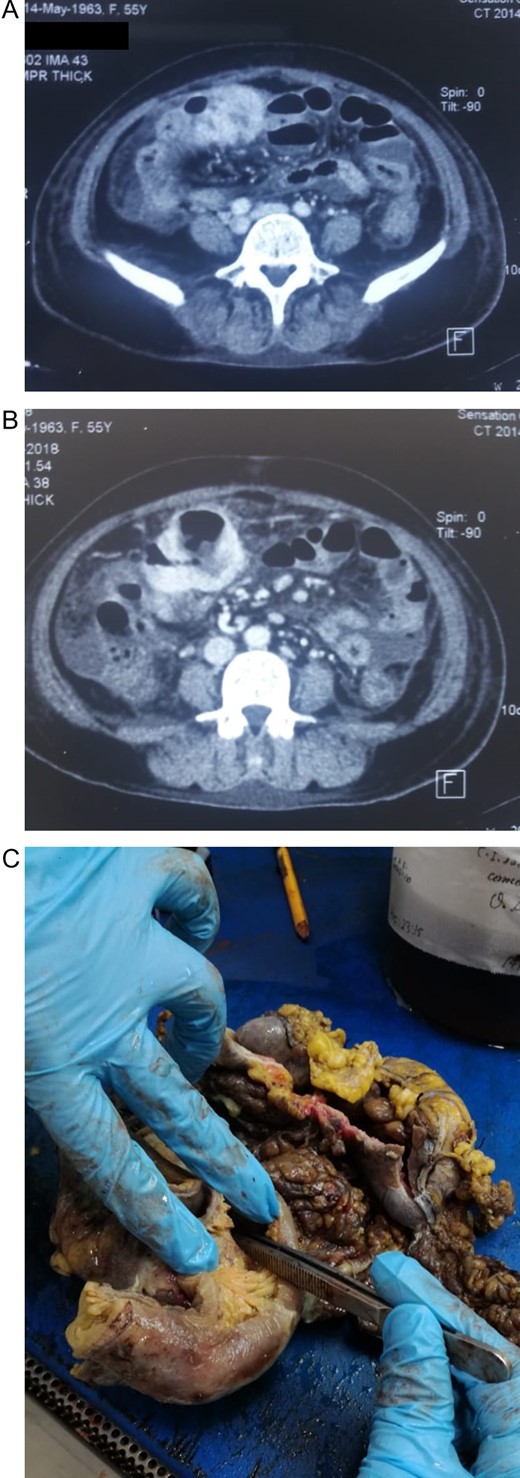 (A) CT revealing a mass in the colon that invaded the small bowel mesentery. (B) Colonic mass, with a cavity filled with fluid and gas. (C) Colonic mass and jejunum, colon with multiple ischemic and necrotic patches.