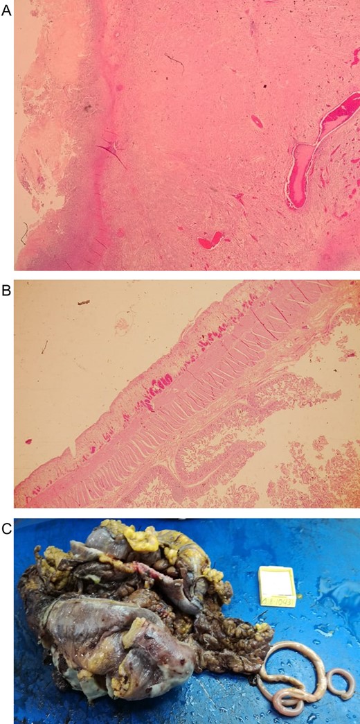 (A) Microscopic view of necrosis in the colonic wall. (B) Microscopic view of the inflammatory reaction in the jejunum wall. (C) Inflammatory colonic mass that compromised the jejunum with the two Ascaris.