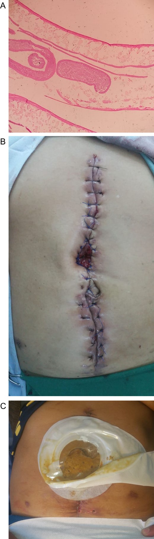 (A) Female worms with multiples eggs in its uterine tubule. (B) Re-laparotomy with the enterocutaneous fistula managed like an ostomy. (C) Follow-up control, with adequate fistula management.