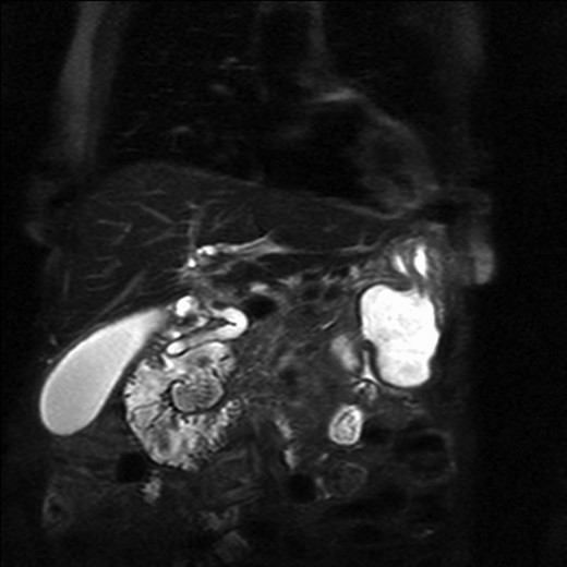 Magnetic resonance imaging with a giant duodenal diverticulum.