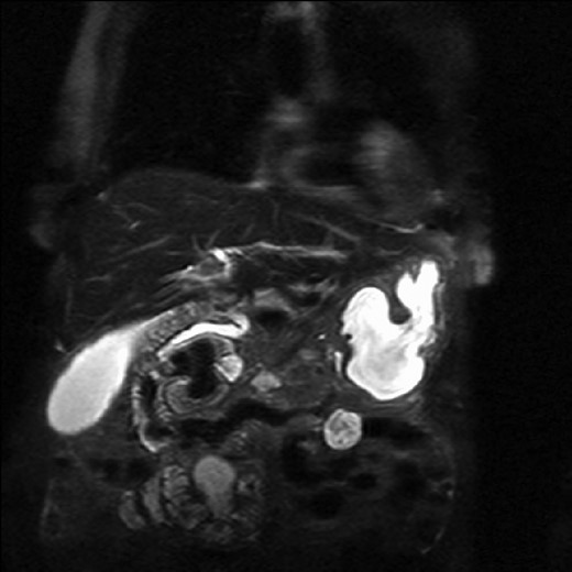 Magnetic resonance imaging with a giant duodenal diverticulum.