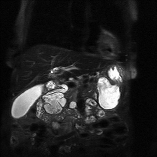 Magnetic resonance imaging with a giant duodenal diverticulum.