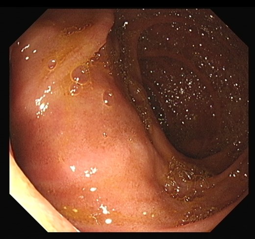 Large duodenal diverticulum.