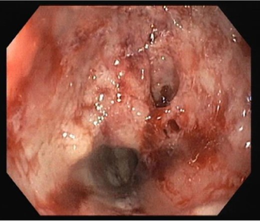 Upper digestive endoscopy.