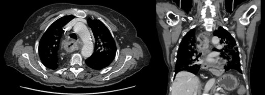 Thoraco-abdomino-pelvic computerized tomography.