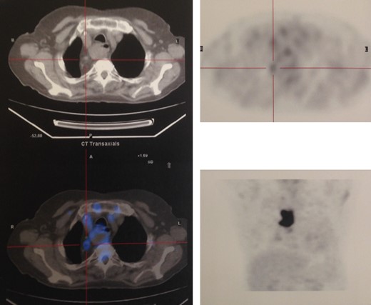 Positron emission tomography.
