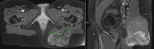 Magnetic resonance imaging described a left gluteal tumor, partly situated within the left gluteus maximus muscle, without infiltrating the skin.