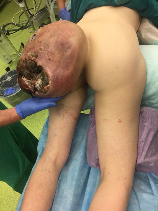 Clinical situation in March 2018 (3 and a half years after primary finding). A gigantic tumor arose of the left gluteal region, partially necrotic, foul and with bleeding ulceration.