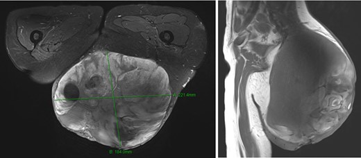 Magnetic resonance imaging showed a very large tumor of the left gluteal region, further infiltrating the left gluteus muscle and now with infiltration of the skin.