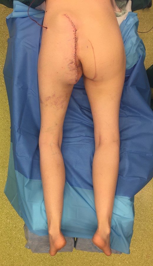 Intraoperative situation directly after wound closure.