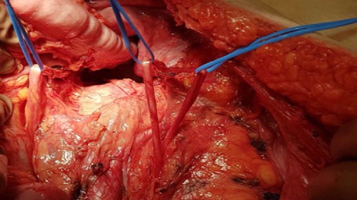 Detailed exposure of both ureters (right ureter without aberration).