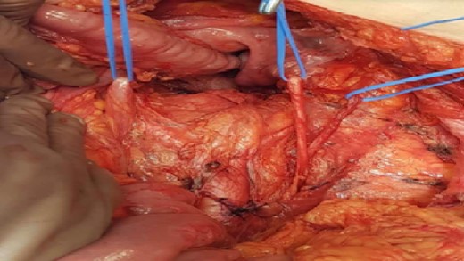 Complete unilateral ureteral duplication of the left ureter.