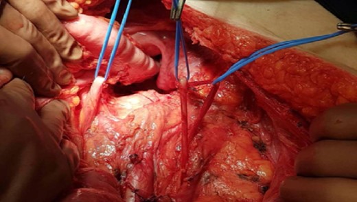 Complete unilateral ureteral duplication of the left ureter.