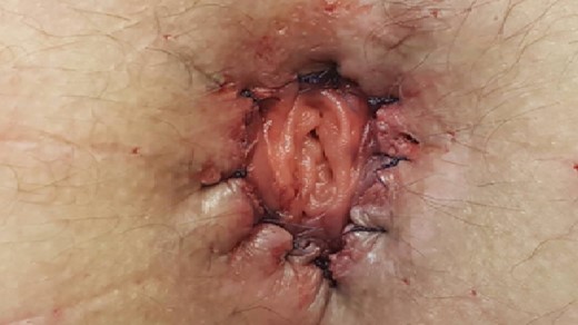Performance of the hand sutured coloanal anastomosis using absorbable sutures placed in between the colon, the external sphincter and the anoderm.