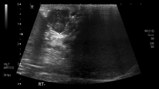 Ultrasound scan showing paratesticular leoimyosarcoma 3 years prior to referral.